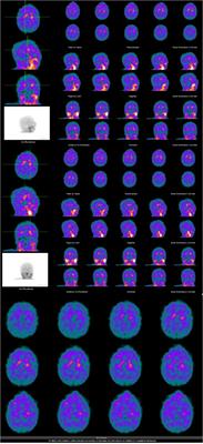 Case Report: Depression × dementia with Lewy bodies in the elderly: The importance of differential diagnosis